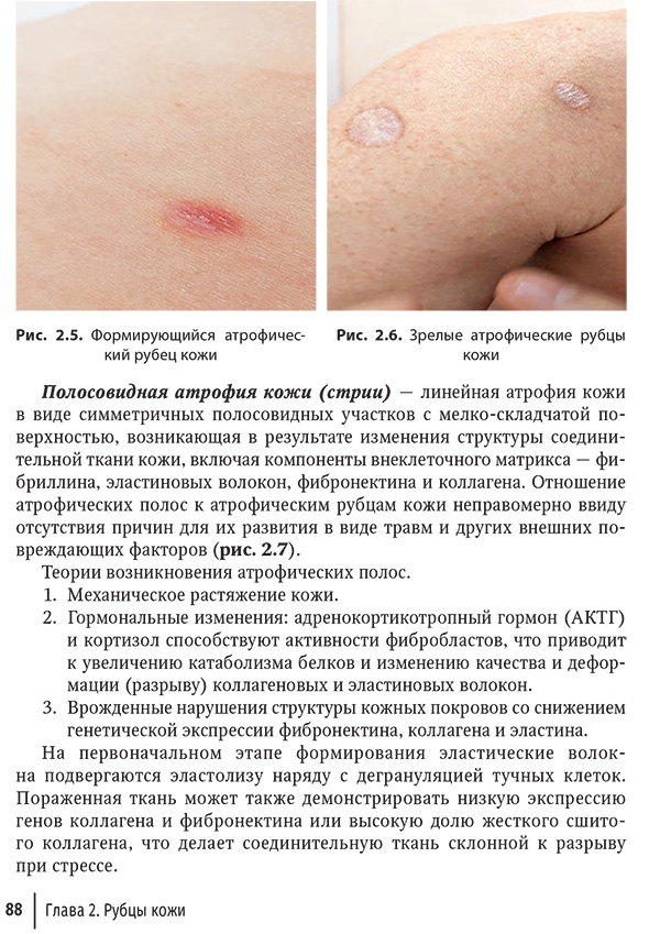 формирующийся атрофический рубец кожи