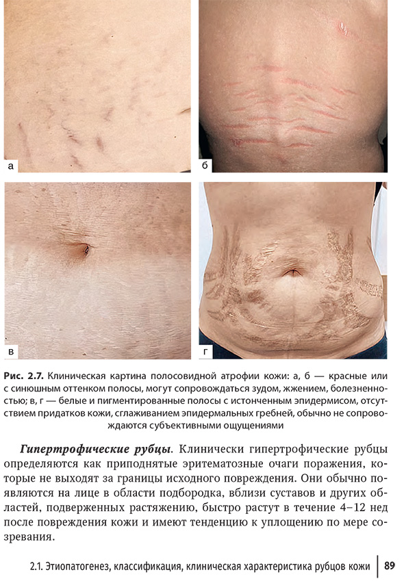 Клиническая картина полосовидной атрофии кожи