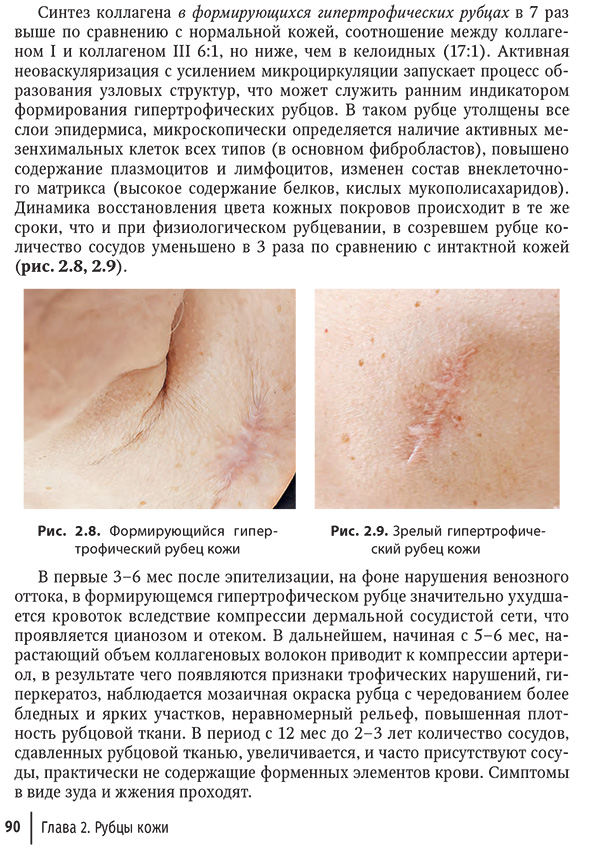 Рис. 2.8. Формирующийся гипертрофический рубец кожи