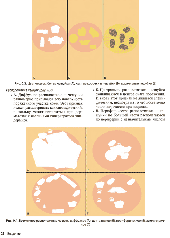 Возможное расположение чешуек: диффузное (А), центральное (Б), периферическое (В),