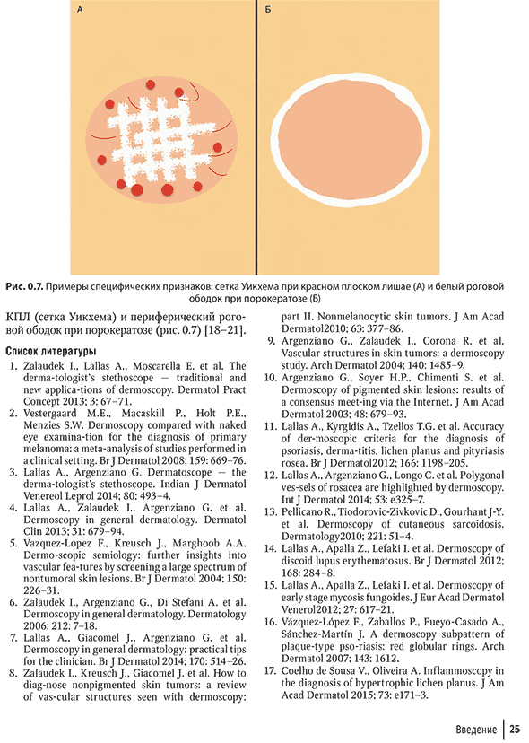 Примеры специфических признаков: сетка Уикхема при красном плоском лишае (А) и белый роговой ободок при порокератозе (6)