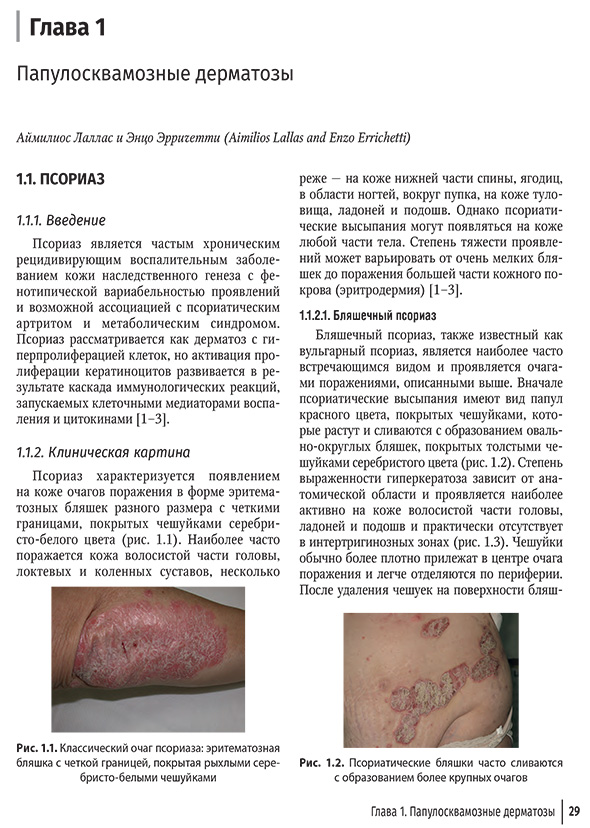 Псориатические бляшки часто сливаются с образованием более крупных очагов