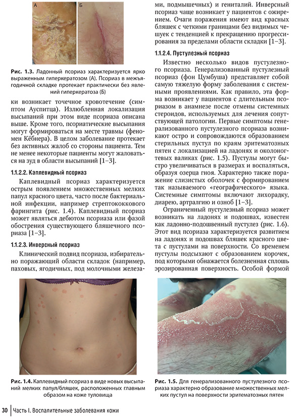 Рис. 1.4. Каплевидный псориаз в виде новых высыпаний мелких папул/бляшек, расположенных главным образом на коже туловища