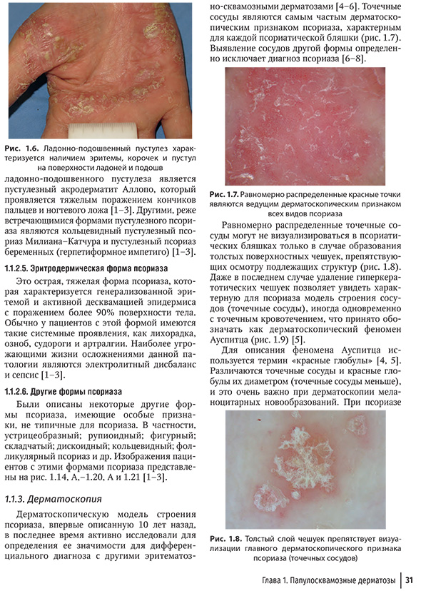 Равномерно распределенные красные точки являются ведущим дерматоскопическим признаком всех видов псориаза