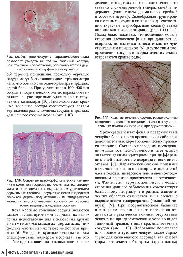 Рис. 1.11. Красные точечные сосуды, расположенные в виде колец, являются специфическим, но нечувствительным признаком псориаза при дерматоскопии