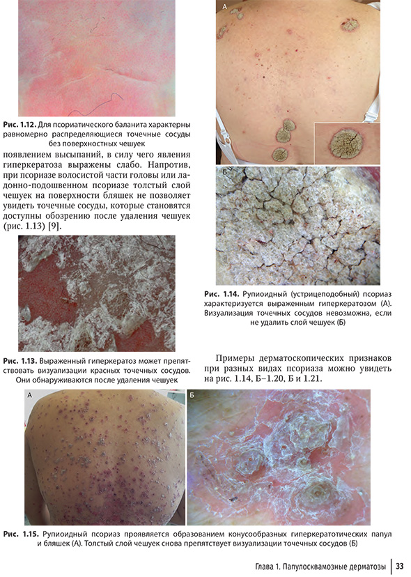 Рупиоидный (устрицеподобный) псориаз характеризуется выраженным гиперкератозом (А)