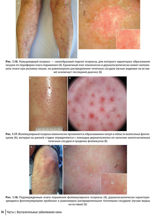Фолликулярный псориаз клинически проявляется образованием папул