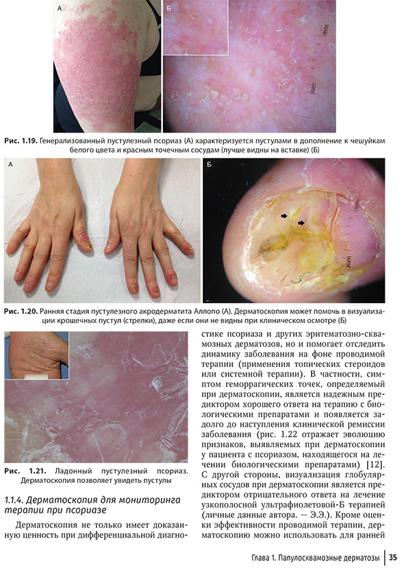 Ладонный пустулезный псориаз. Дерматоскопия позволяет увидеть пустулы