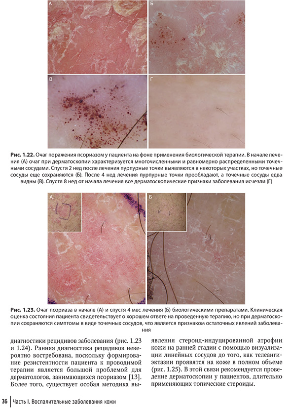 Очаг псориаза в начале (А) и спустя 4 мес лечения (Б) биологическими препаратами.