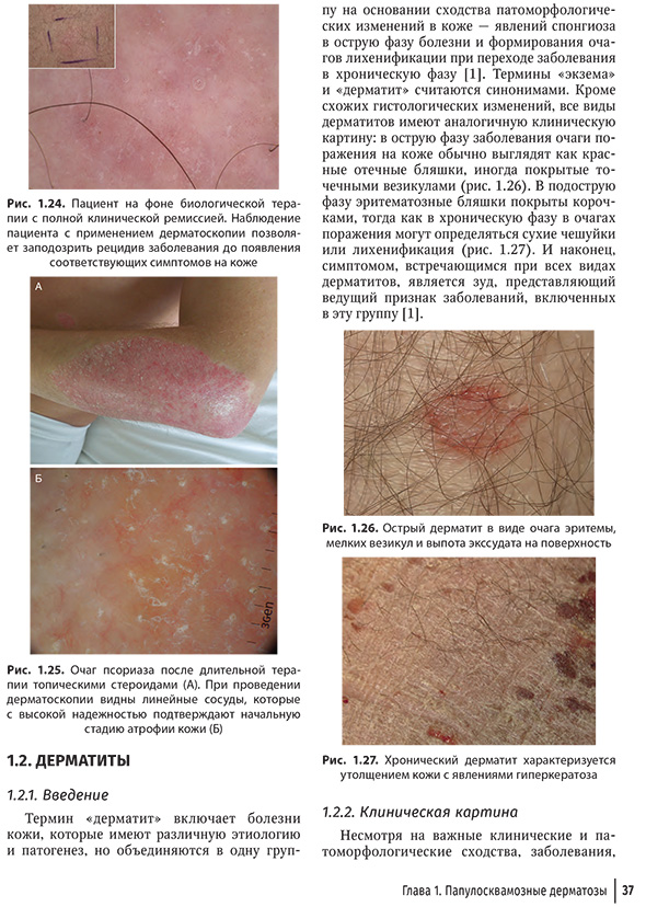 Рис. 1.26. Острый дерматит в виде очага эритемы, мелких везикул и выпота экссудата на поверхность