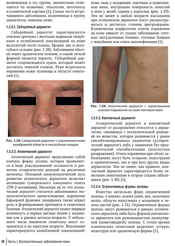 Себорейный дерматите поражением кожи межброеной области и носогубных складок