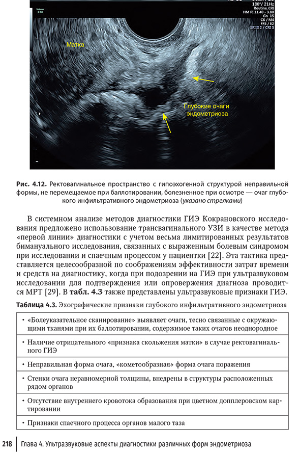 Ректовагинальное пространство с гипоэхогенной структурой Ректовагинальное пространство с гипоэхогенной структурой