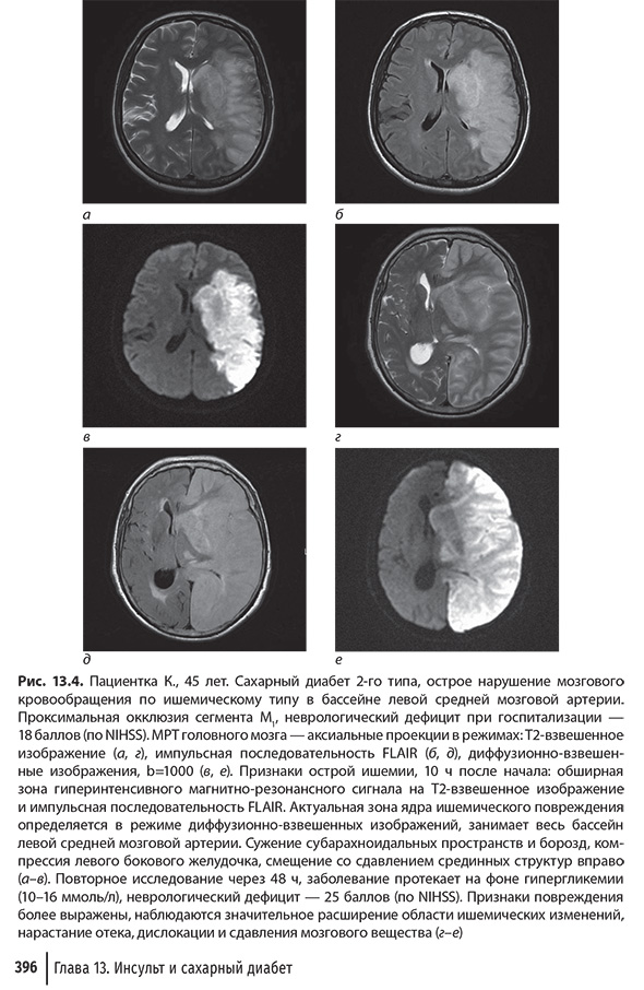 Пациентка К., 45 лет. Сахарный диабет 2-го типа, острое нарушение мозгового кровообращения 