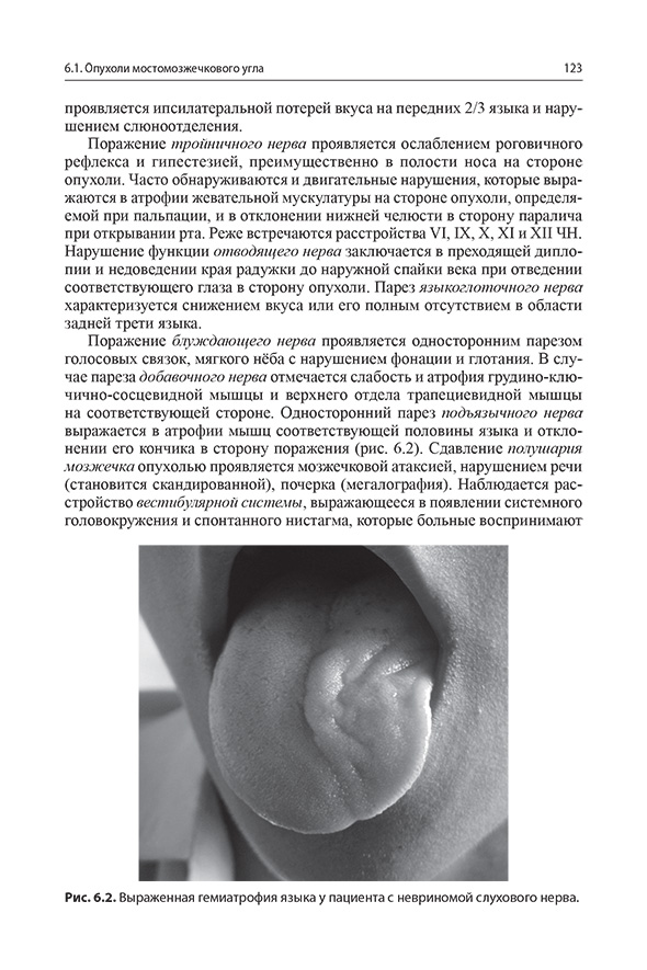 Выраженная гемиатрофия языка у пациента с невриномой слухового нерва.