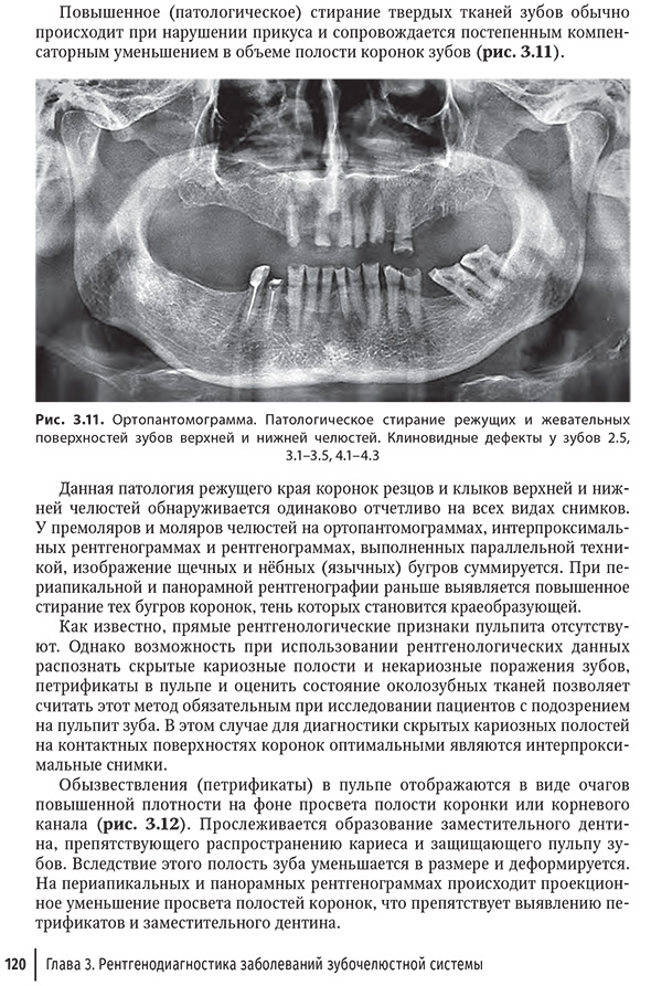 Рис. 3.11. Ортопантомограмма. Патологическое стирание режущих и жевательных поверхностей зубов верхней и нижней челюстей. Клиновидные дефекты у зубов 2.5, 3.1-3.5, 4.1-4.3. Рис. 3.11. Ортопантомограмма. Патологическое стирание режущих и жевательных поверхностей зубов верхней и нижней челюстей. Клиновидные дефекты у зубов 2.5, 3.1-3.5, 4.1-4.3.