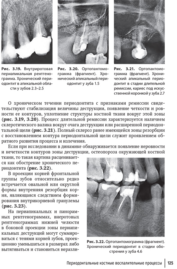 Ортопантомограмма (фрагмент). Хронический периодонтит в стадии обострения у зуба 4.6. Ортопантомограмма (фрагмент). Хронический периодонтит в стадии обострения у зуба 4.6.
