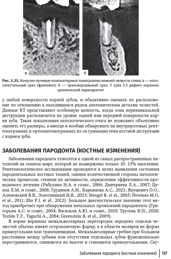 Конусно-лучевые компьютерные томограммы нижней челюсти слева Конусно-лучевые компьютерные томограммы нижней челюсти слева