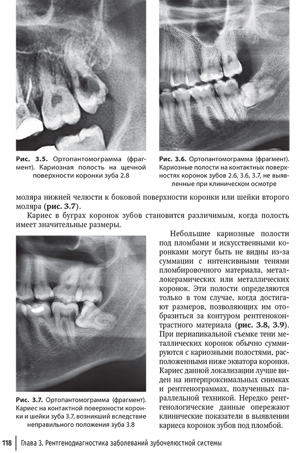 Ортопантомограмма (фрагмент). Кариозная полость на щечной поверхности коронки зуба 2.8 Ортопантомограмма (фрагмент). Кариозная полость на щечной поверхности коронки зуба 2.8