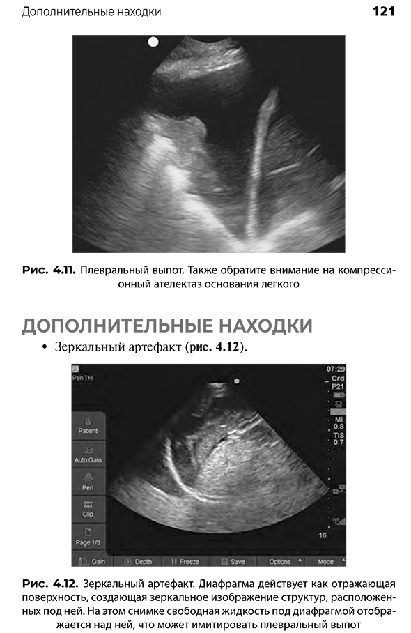 Рис. 4.12. Зеркальный артефакт. Диафрагма действует как отражающая поверхность, создающая зеркальное изображение структур