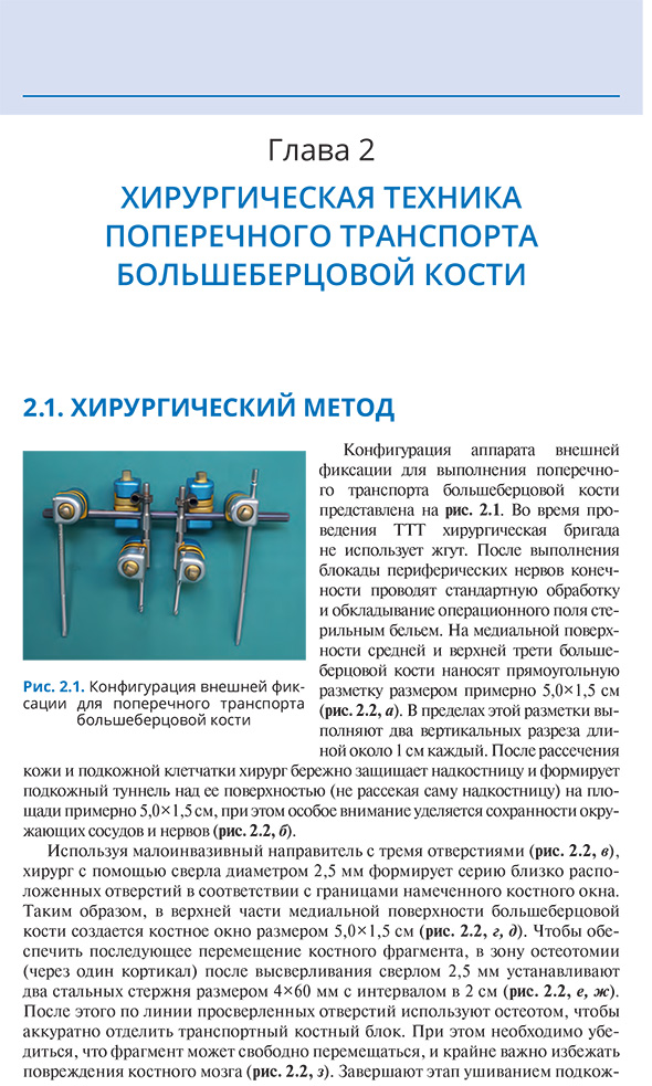 Рис. 2.1. Конфигурация внешней фиксации для поперечного транспорта большеберцовой кости
