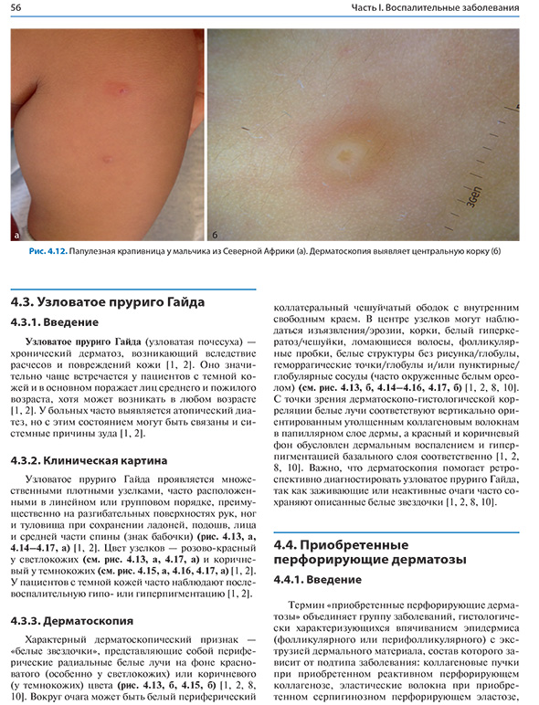 Папулезная крапивница у мальчика из Северной Африки
