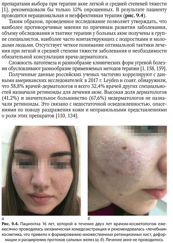 Пациентка 16 лет, которой в течение двух лет врачом-косметологом ежемесячно проводилась механическая комедоэкстракция и рекомендовалась «лечебная» Пациентка 16 лет, которой в течение двух лет врачом-косметологом ежемесячно проводилась механическая комедоэкстракция и рекомендовалась «лечебная»