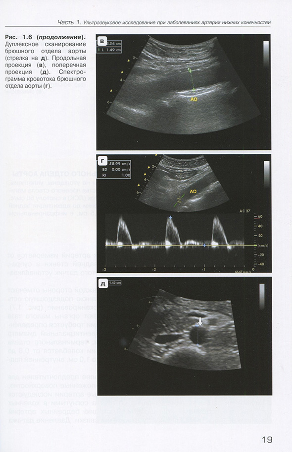 Дуплексное сканирование брюшного отдела аорты