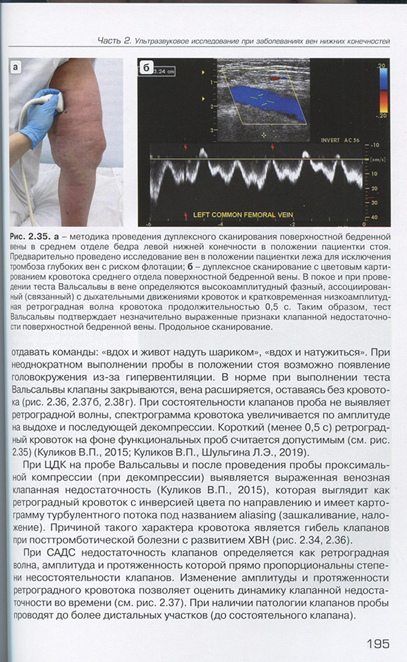 Рис. 2.35. а - методика проведения дуплексного сканирования поверхностной бедренной вены 