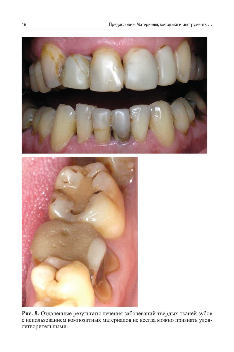 Отдаленные результаты лечения заболеваний твердых тканей зубов