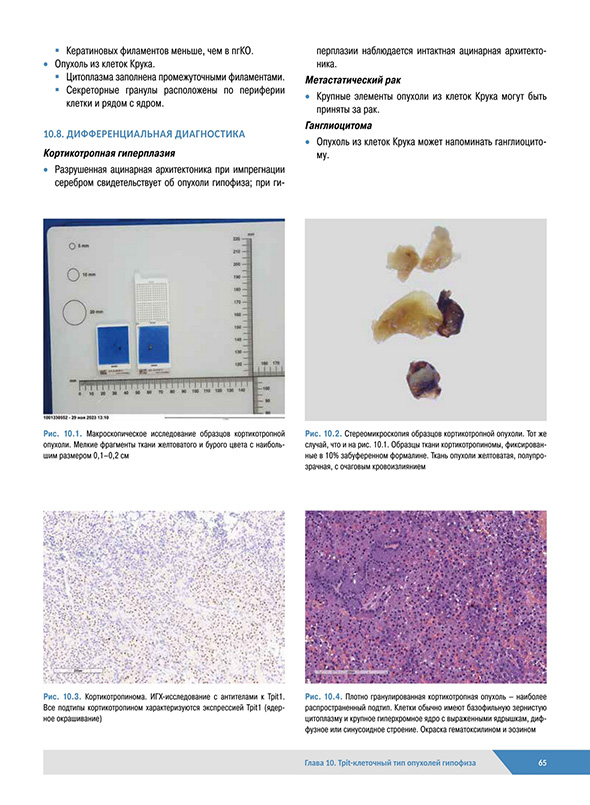 Мезенхимальные и гемопоэтические опухоли гипофиза Мезенхимальные и гемопоэтические опухоли гипофиза