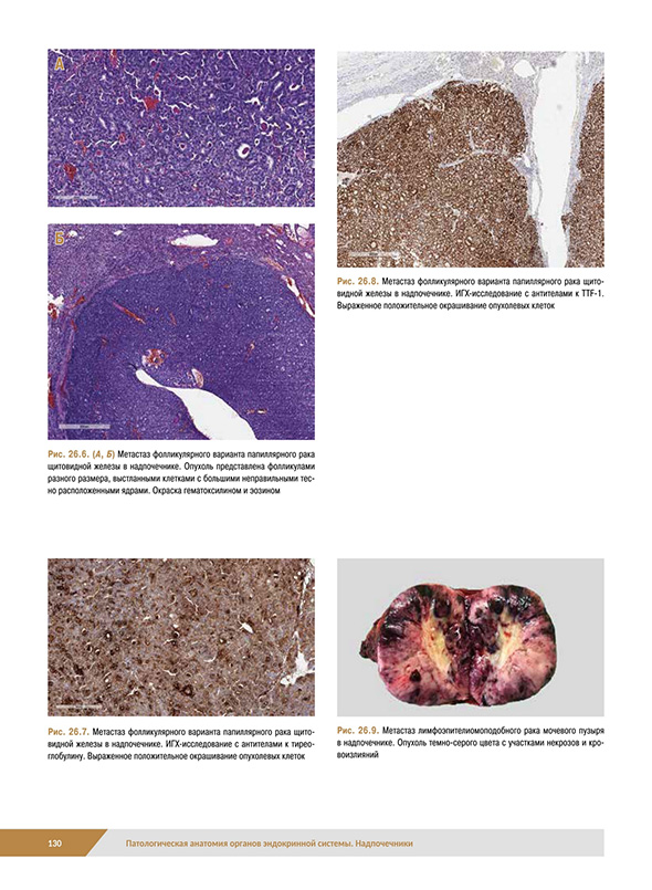 Метастаз фолликулярного варианта папиллярного рака Метастаз фолликулярного варианта папиллярного рака