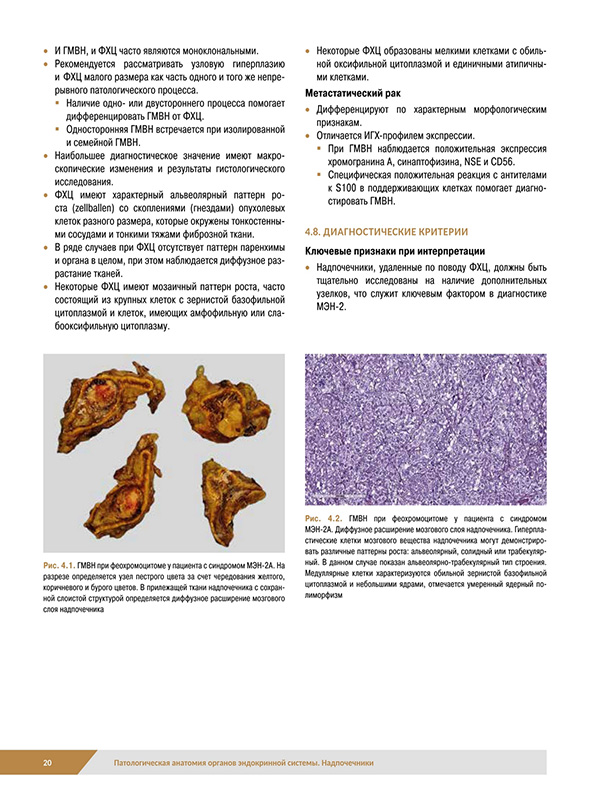 ГВМН при феохромоцитоме. ГВМН при феохромоцитоме.