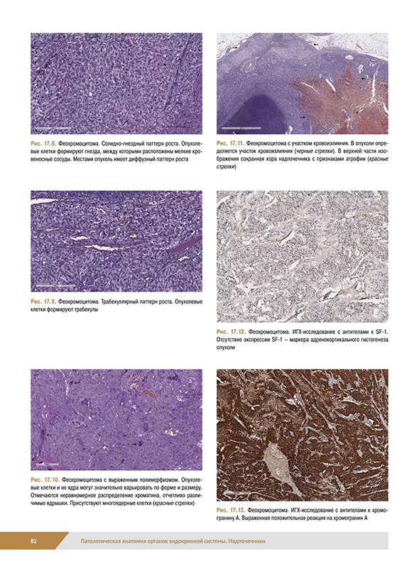 Феохромоцитома Феохромоцитома