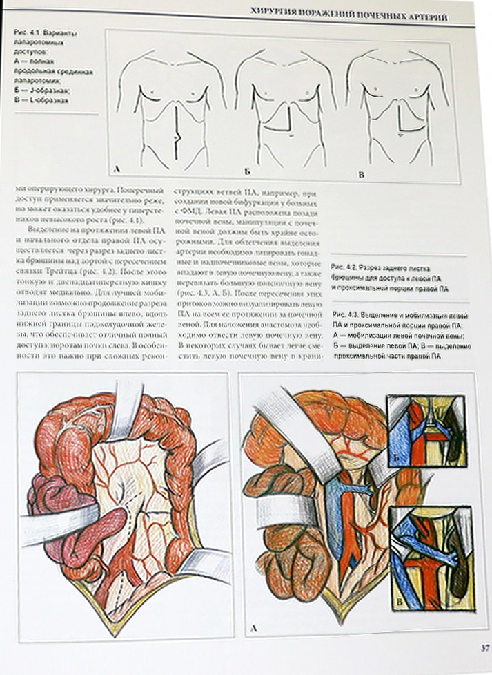 Пример страницы из книги "Хирургия почечных сосудов" - А. Ш. Ревишвили, А. В. Покровский, А. Е. Зотиков