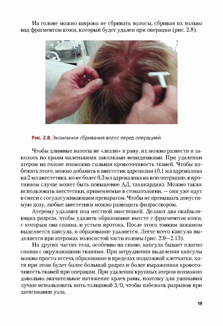Рис. 2.8. Экономное сбривание волос перед операцией