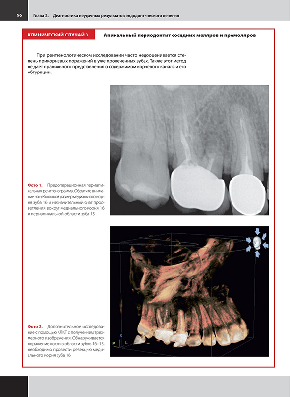 Апикальный периодонтит соседних моляров и премоляров.