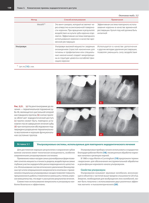 Клинические примеры эндодонтического доступа.