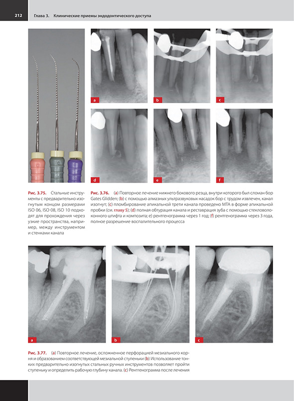 Клинические примеры эндодонтического доступа.