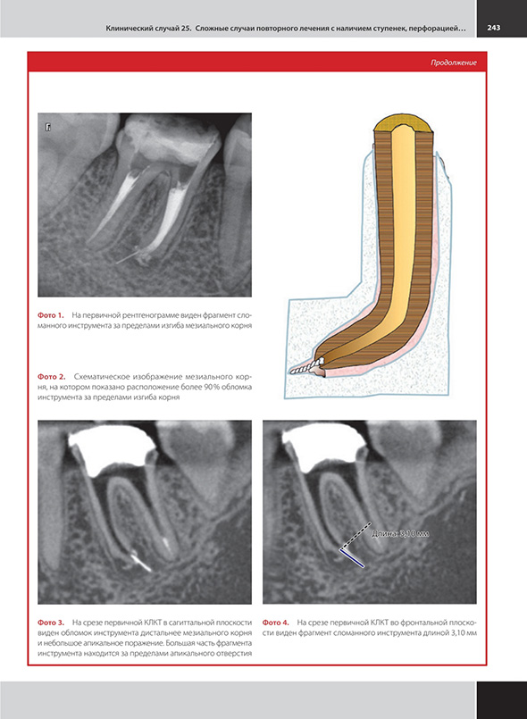 Сложные случаи повторного печения с наличием ступенек.