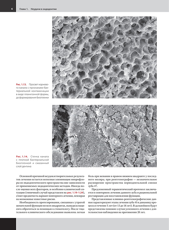 Рис. 1.14. Стенка канала с плотной бактериальной биопленкой и смазанный слой дентина.