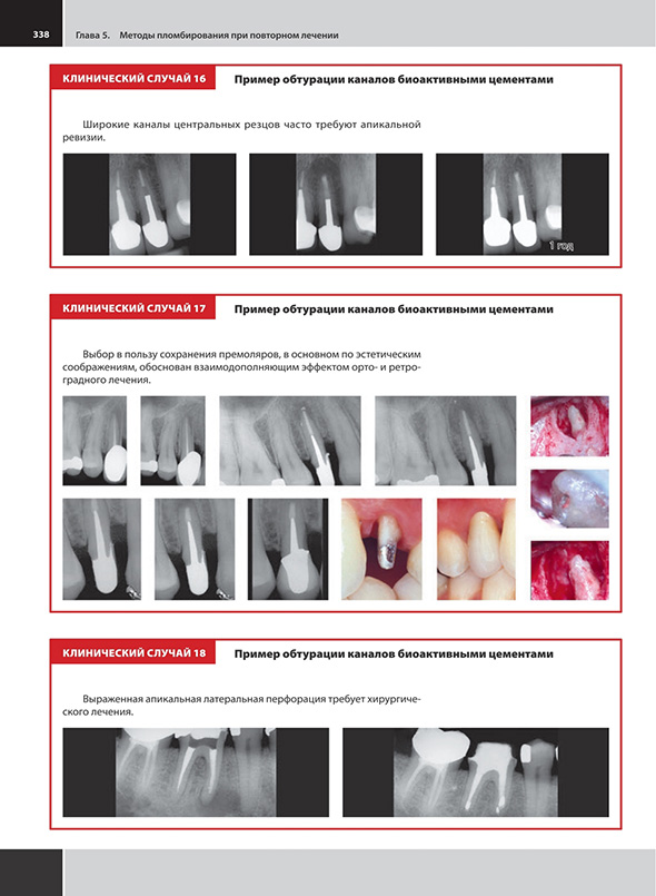 Пример обтурации каналов биоактивными цементами