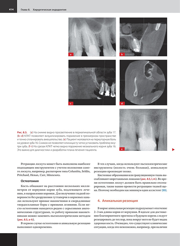 Хирургическая эндодонтия