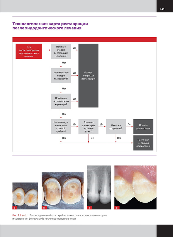 Технологическая карта реставрации после эндодонтического лечения
