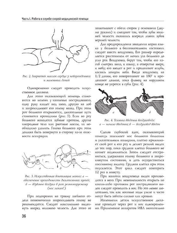 Закрытый массаж сердца: а — зона приложения усилий; б — техника массажа