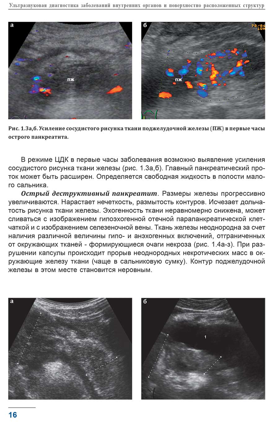 Рис. 1.3а, б. Усиление сосудистого рисунка ткани поджелудочной железы (ПЖ) в первые часы острого панкреатита