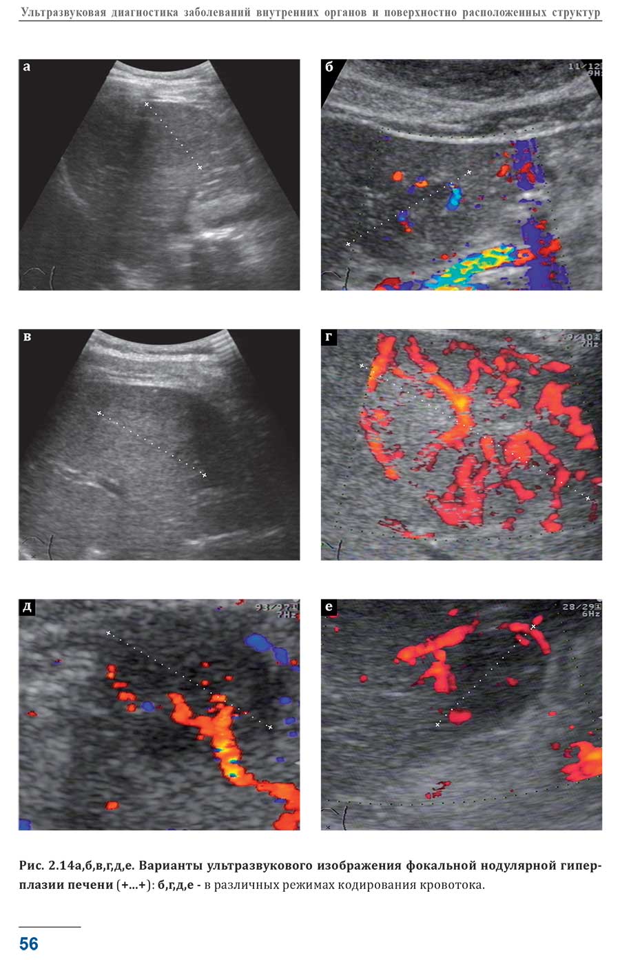 Варианты ультразвукового изображения фокальной нодулярной гиперплазии печени (+...+): б,г,Д,е - в различных режимах кодирования кровотока.
