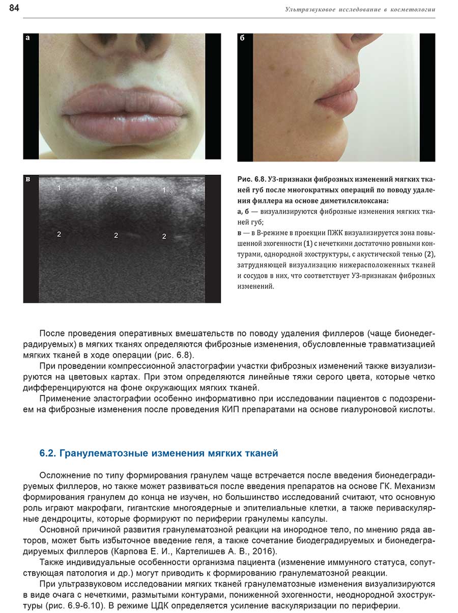 Рис. 6.8. УЗ-признаки фиброзных изменений мягких тканей губ после многократных операций по поводу удаления филлера 