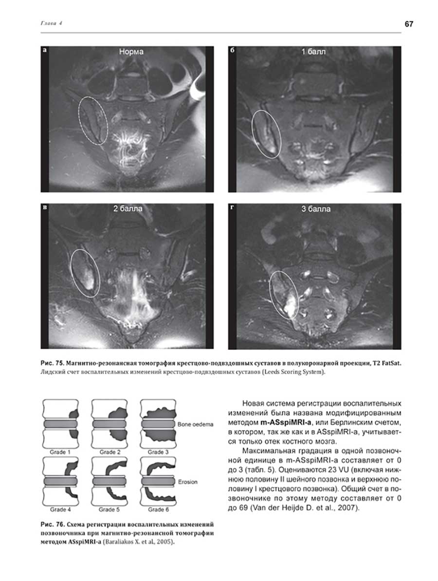 Рис. 75. Магнитно-резонансная томография крестцово-подвздошных суставов вполукоронарной проекции.