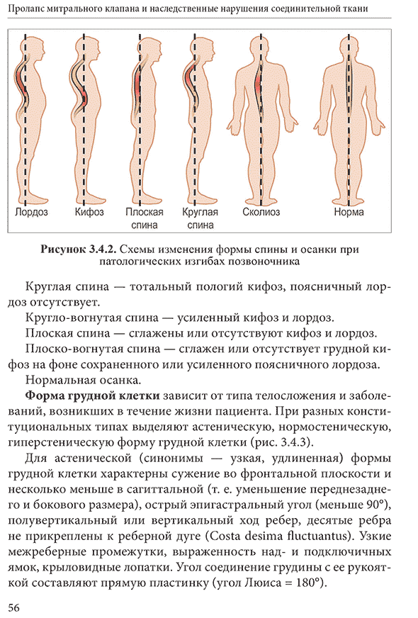 Рисунок 3.4.2. Схемы изменения формы спины и осанки при патологических изгибах позвоночника