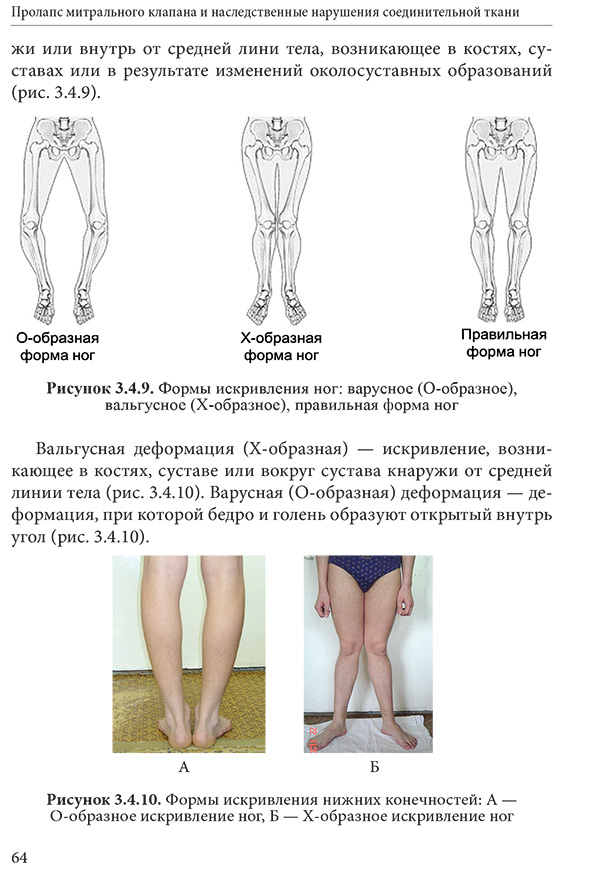 Рисунок 3.4.10. Формы искривления нижних конечностей: